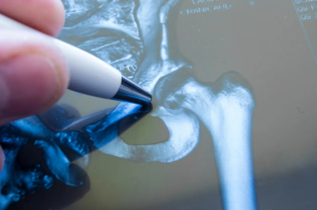 Arthritis and Joint Pain in Hip