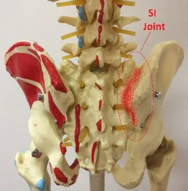 Hip pain: sacroiliac SI joint syndrome