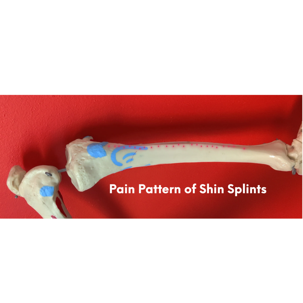 shin splints leg pain