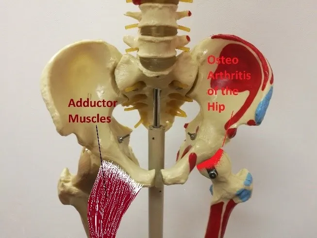 hip arthritis and pulled groin