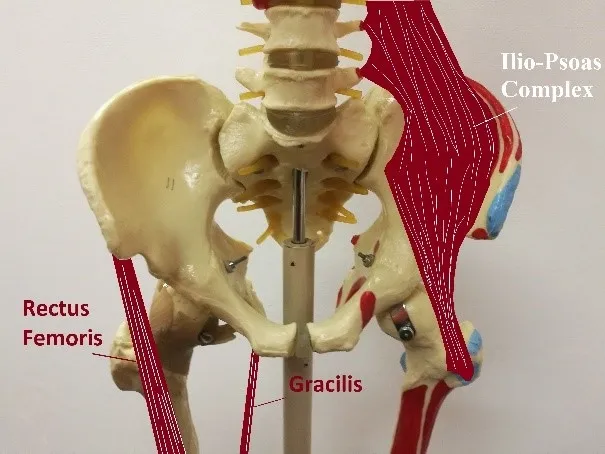 Iliopsoas hip flexor pain