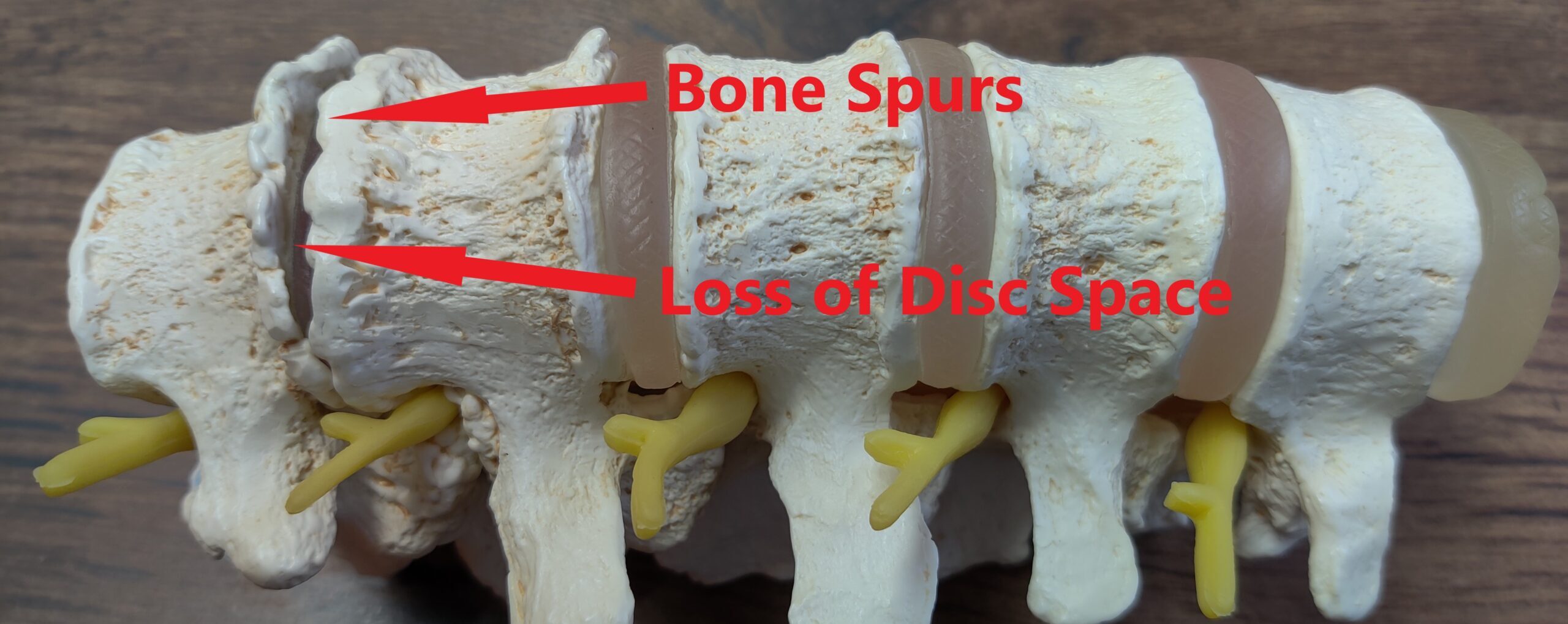 Spondylosis of the Spine