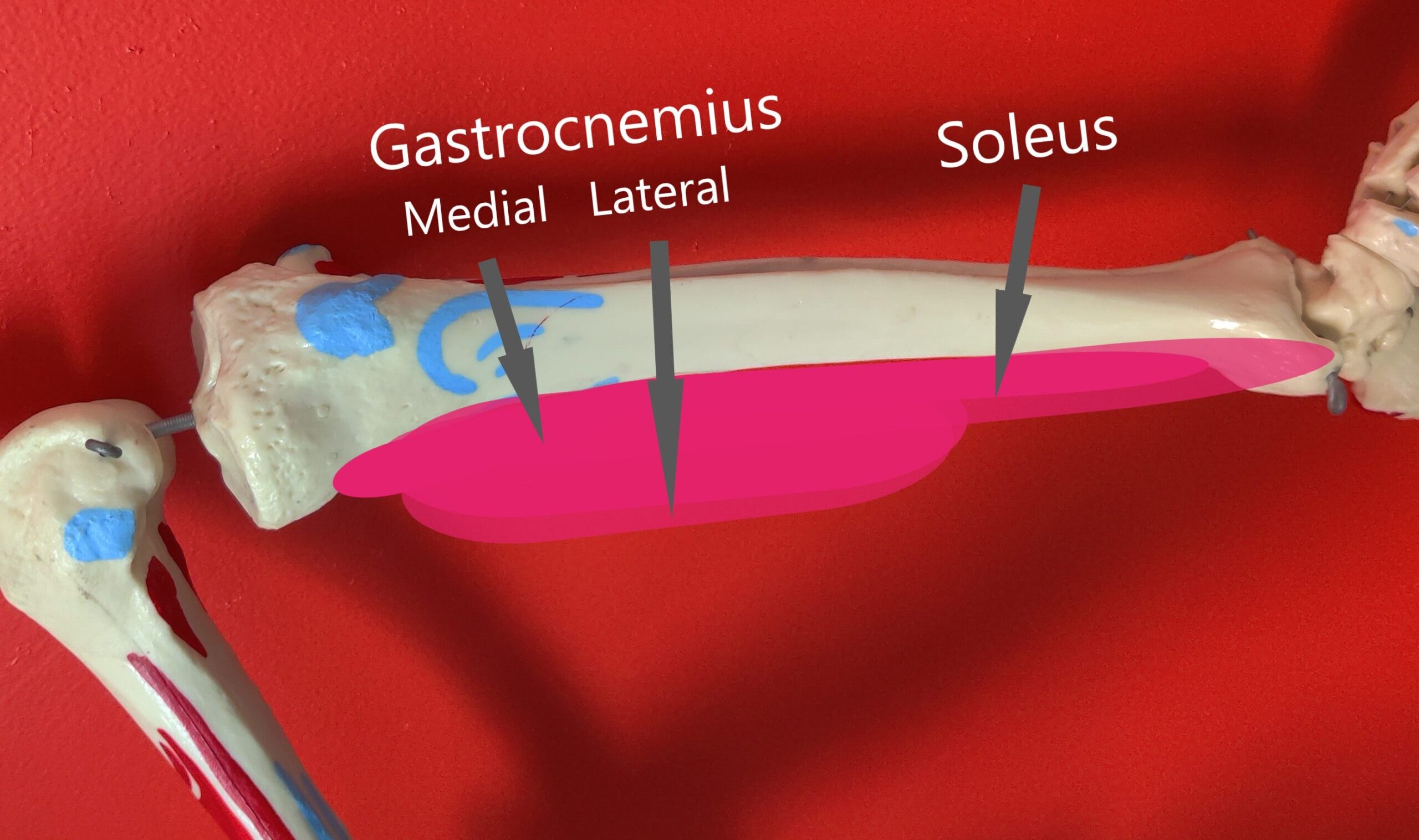 Calf Muscles: Gastrocnemius Soleus Leg pain